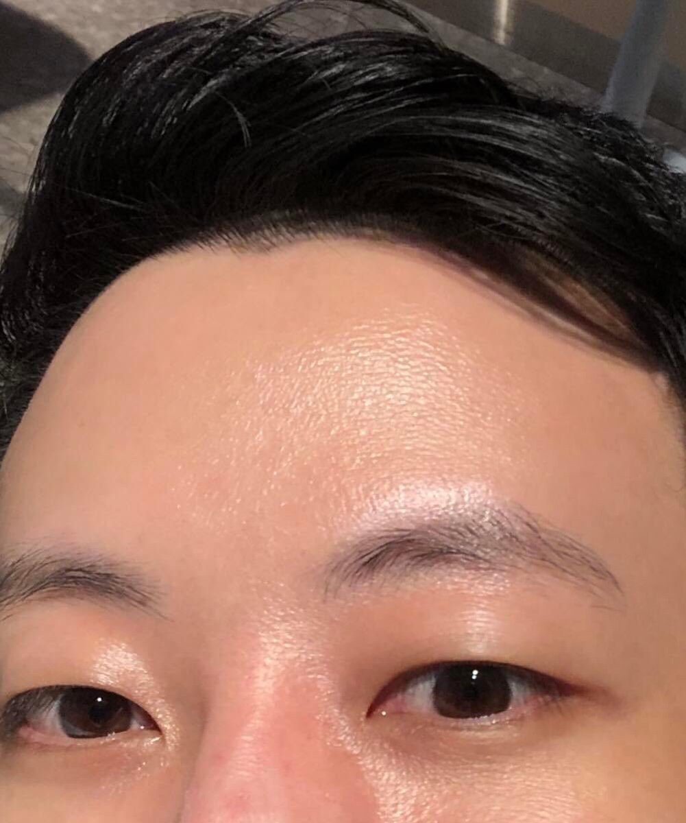 nutthonx's tweet image. 2 อาทิตย์หลังจากไปทำ Glow Code ที่ SLC Siam Laser Clinic มาครับ ผิวฉ่ำสุด ริ้วรอยเล็กๆลดเลือนลง ใต้ตาคือดีขึ้นมากกกก 💙 
#GlowCode
#slcclinic