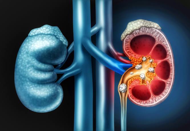 Böbrek taşı olan hastalarda en sık görülen şikayet ağrıdır. Diğer belirtiler:
-İdrar yaparken ağrı
-İdrarda kan
-Mide bulantısı ya da kusma
-Sık idrara çıkma 
-Ateş
Böbrek taşının boyutu ve konumuna göre tedavi şekli belirlenir.

Uzmanlar burada👇 
danisanapp.com/goapp