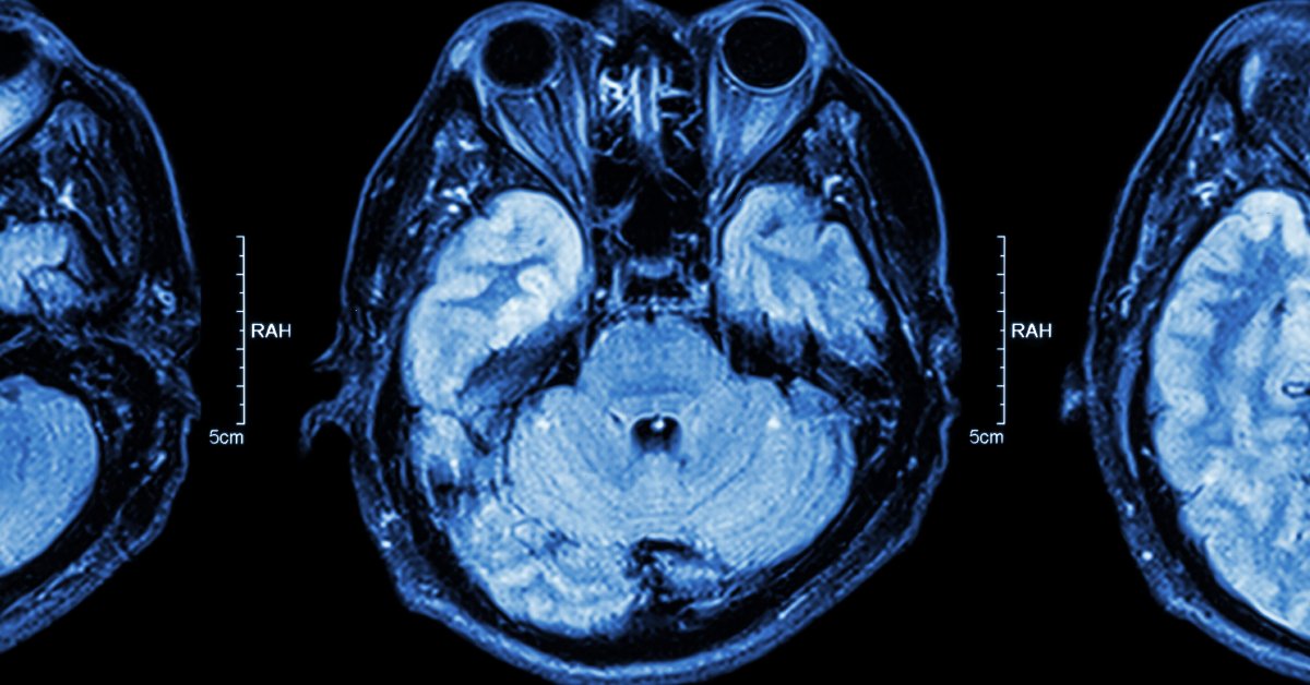 WebMD's tweet image. Just 6 months of moderate exercise -- walking or pedaling a stationary bike -- was equivalent to shaving 9 years from older adults' brain age, the study found. wb.md/3F58MoL