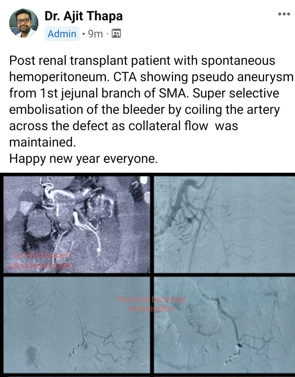 Embolotherapy for internal bleeding
#interventionalradiology
#interventionaloncology