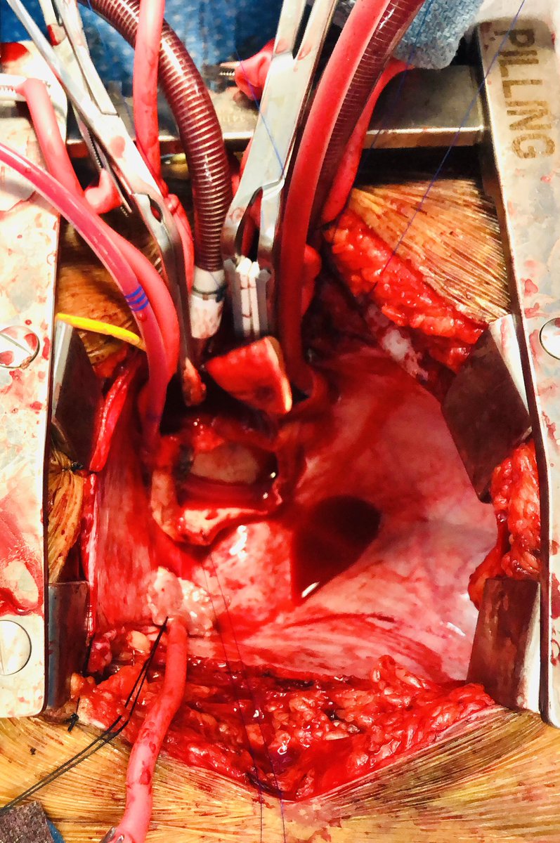 AVR_MVR's tweet photo. Another year in the books.  I’m grateful everyday for the opportunity to help change lives. Here, an empty pericardium and @VUMC_heart fellow @donaldmoe doing @VUMCTransplant 125th and final heart transplant for 2021. @AshShahMD https://t.co/BTstmuzYNy