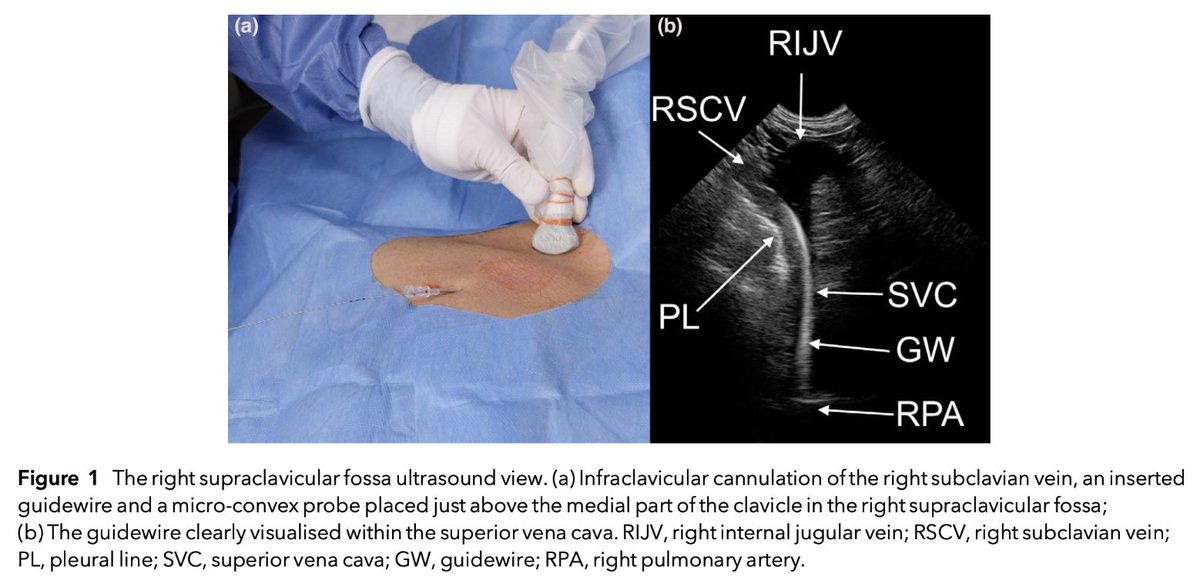 Anaes_Journal's tweet photo. 🔐This new prospective observational study from @robinlunden and @OBorgquist demonstrates that the right supraclavicular fossa ultrasound view is useful for correct catheter tip positioning in right subclavian vein catheterisation.

🔗https://t.co/Y7NKMB0vtB https://t.co/Qoy32mTCvB