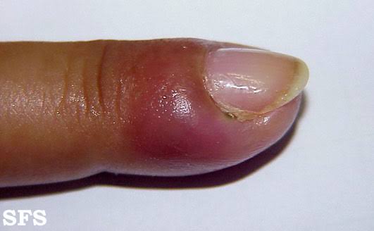 melanotic whitlow Melanoma of the proximal nail fold mimicking Hutchinson sign