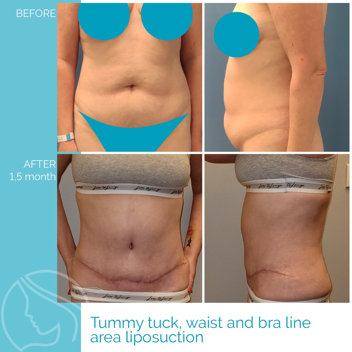 Nordesthetics Clinic on X: The timeline for #tummytuck recovery