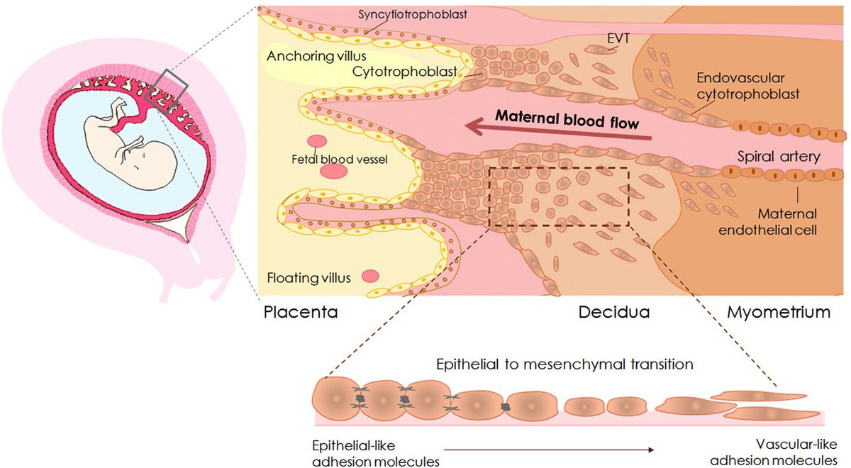 AJOG Expert Review in Preeclampsia:  Decidualization resistance in the origin of preeclampsia ow.ly/P0j350FWVVi