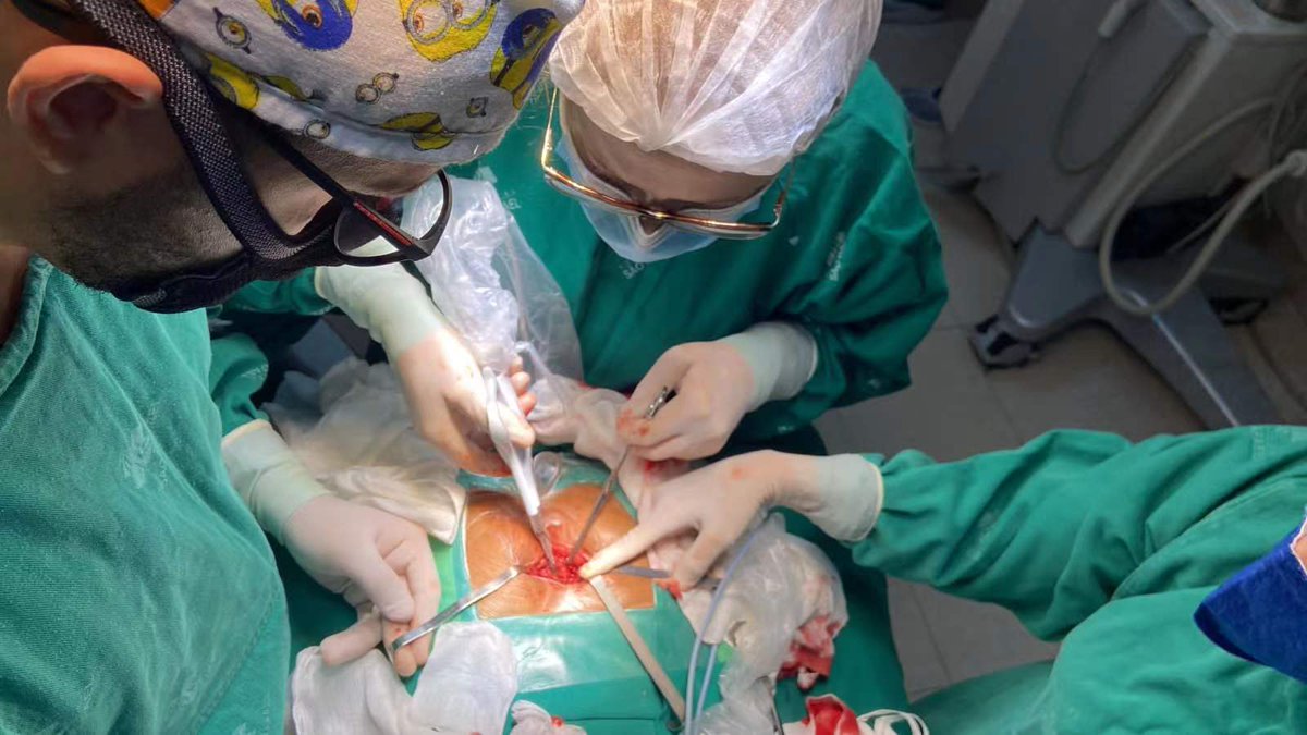 InnolconMedical's tweet photo. Sacrococcygeal teratoma removal in a 2 years old child with #InnolconSS9 in Brazil
SCT,a tumor that develops before birth and grows from a baby's coccyx. 
Many thanks to this #pediatric doctor! Much honored to take part in this surgery and relieve the pain of this little patient. https://t.co/IM9LlJW0Kh