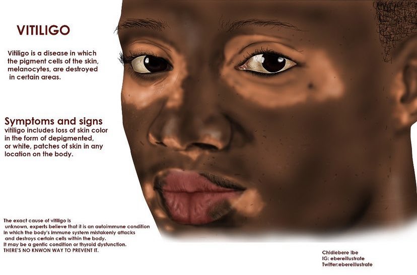 InclusNous's tweet photo. La #représentation des corps noirs en médecine est primordiale et @ebereillustrate l’a bien compris. Étudiant en médecine nigérian, il note le manque de diversité dans les manuels dès son entrée en école et décide d’y remédier. Ses croquis inclusifs sont ajd mondialement connus. https://t.co/vSupX72D0P