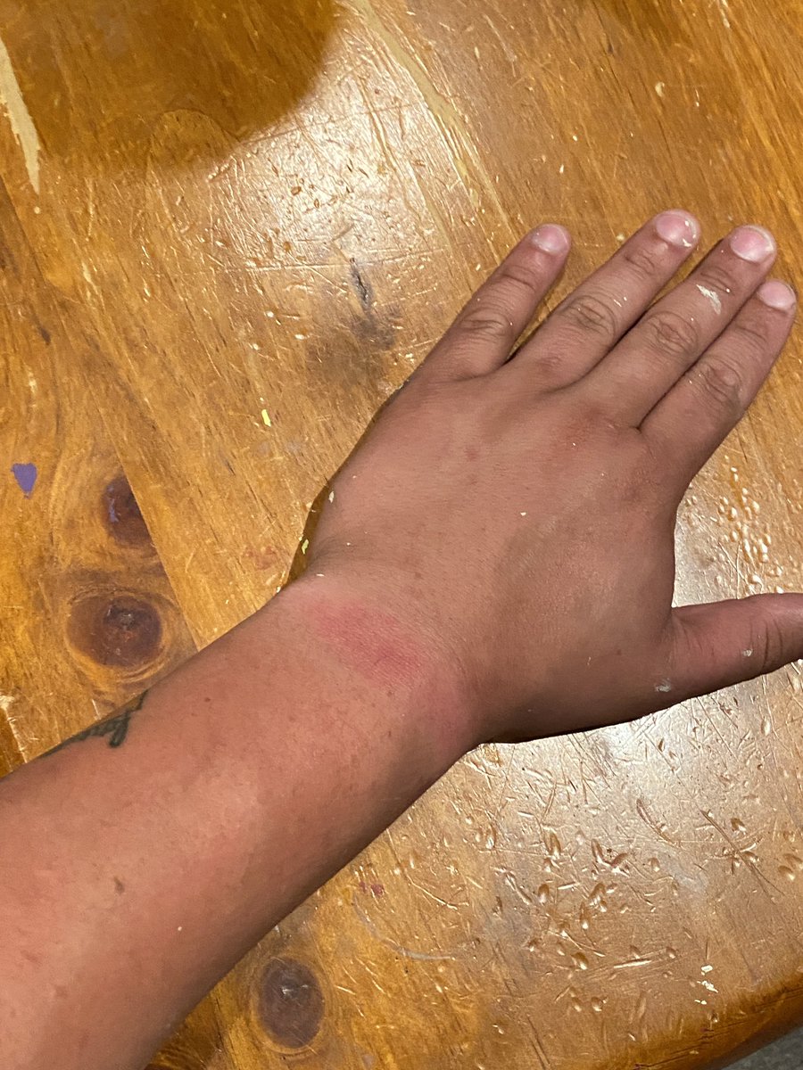 chefjamesanth's tweet photo. @Apple any reason as to why my #AppleWatch would be burning me? #applewatchburn #apple #burn https://t.co/JRk8n0h1JG