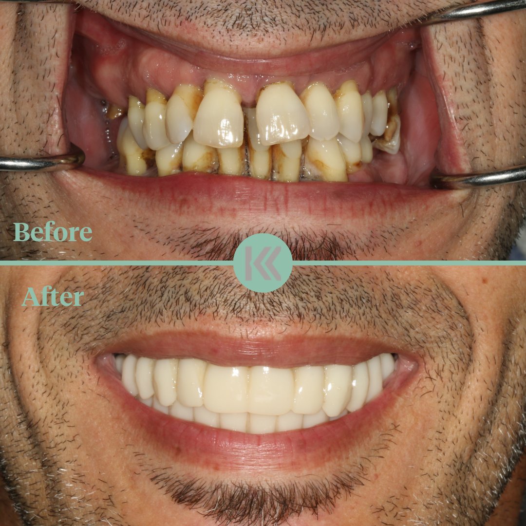 KeppelDentistry's tweet photo. Get The Smile Of Your Dreams Here At Keppel Advanced Dentistry 💠⁠
⁠
To book your FREE Smile Makeover Consultation please call us on 020 8068 1705
⁠
#porcelainveneers #whiteteeth #straightteeth #crowns #veneers https://t.co/UuQRaTdElO
