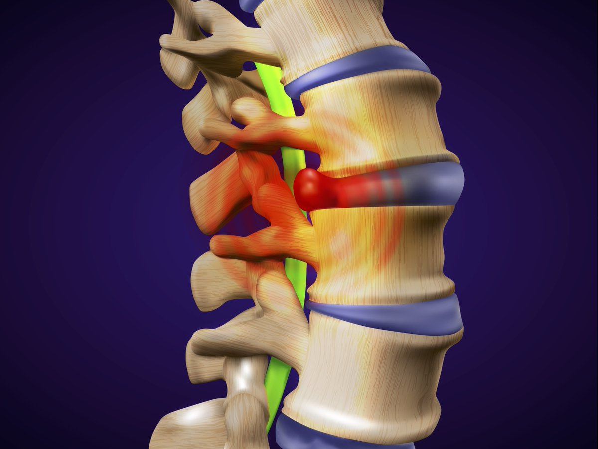 AlexPrinceOsteo's tweet photo. How can #BristolOsteopaths help patients with #SlippedDiscs? Find out here from #AlexPrinceOsteopathy: https://t.co/imfNJXHB6p https://t.co/ZRq1Vh751q