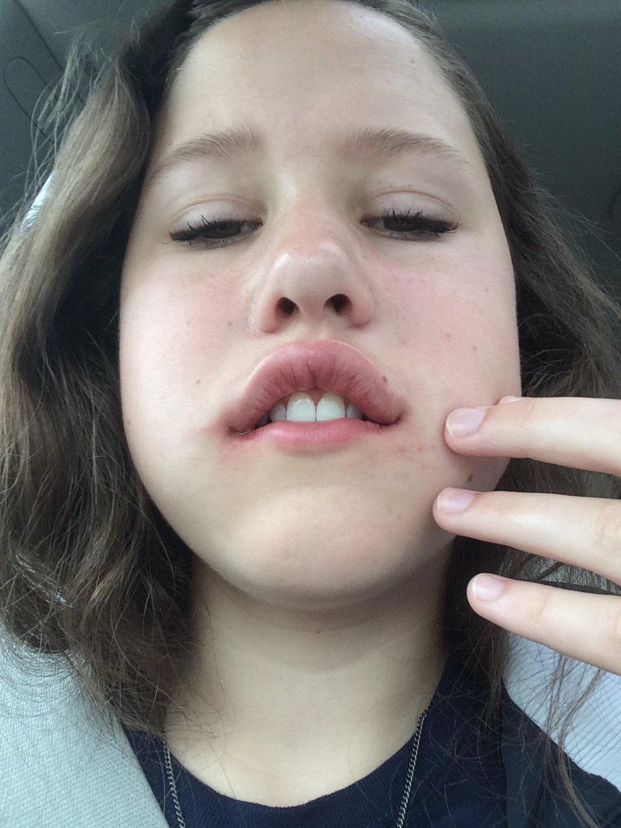 annaewoods's tweet photo. A short story of woods girls post wisdom teeth surgery choose your fighter https://t.co/ybKHTeKeCj
