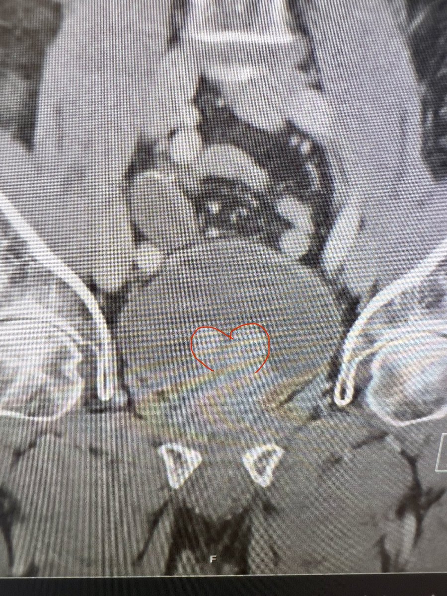 Urology_Fadi's tweet photo. What a way to end #2021…

Heart-shaped median lobe of the #prostate 😍

Wishing you all a heart filled with love and joy for the year #2022 

#surgtweet
#medtweet
#UroTweet
#urology
#new_year https://t.co/90ILfymlJi