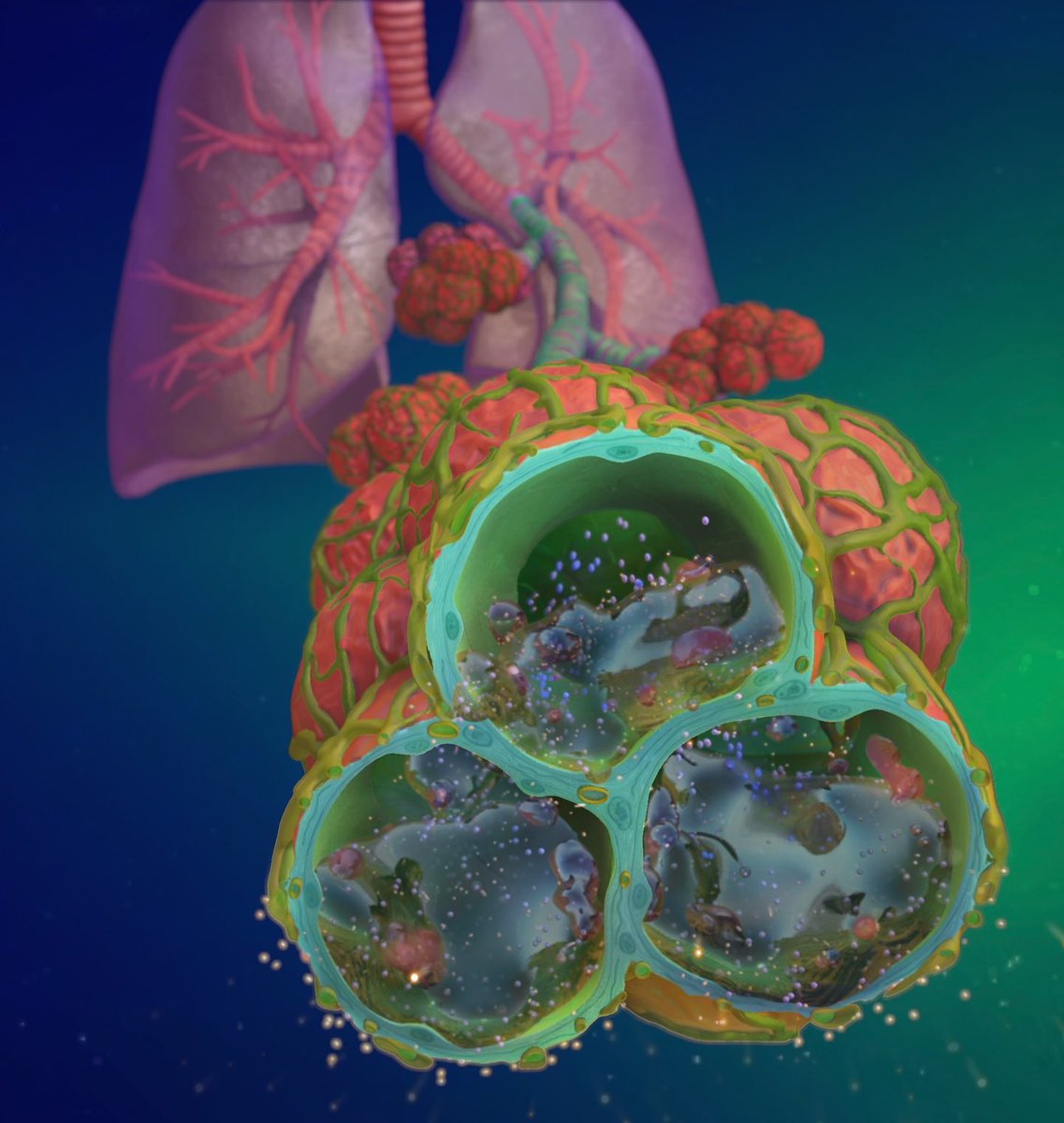 yosef_skampson's tweet photo. Slightly psychedelic cross section of alveoli in a lung with pulmonary edema 🫁 
#psychedelicanatomy #pulmonaryedema #alveoli #medicalillustration #sciart #lung #bronchi https://t.co/pkBh1ojNbt