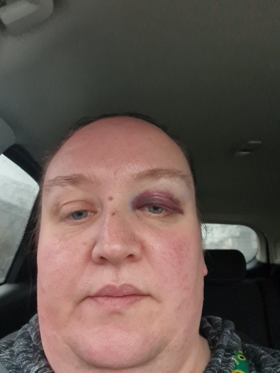 So this day 2 after a slip getting in the shower