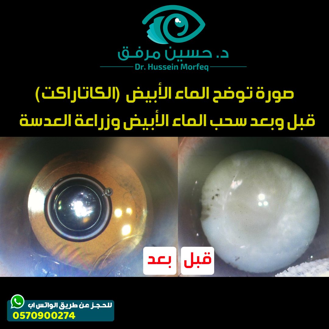 الماء الأبيض عبارة عن عتامة تصيب عدسة العين مما يؤدي الى تصلبها وتغير لونها. ينصح باجراء عملية الماء الابيض واستبدال العدسة مبكراً في حال تضرر النظر بسببها قبل تطور الحالة (تكون اللون الأبيض او البني في الحالات المتقدمة)

#ماء_أبيض #كاتاراكت #عيون #جدة <a href="/6abeb_/">#صوت_الطبيب🩺</a> @Voice_6abeb