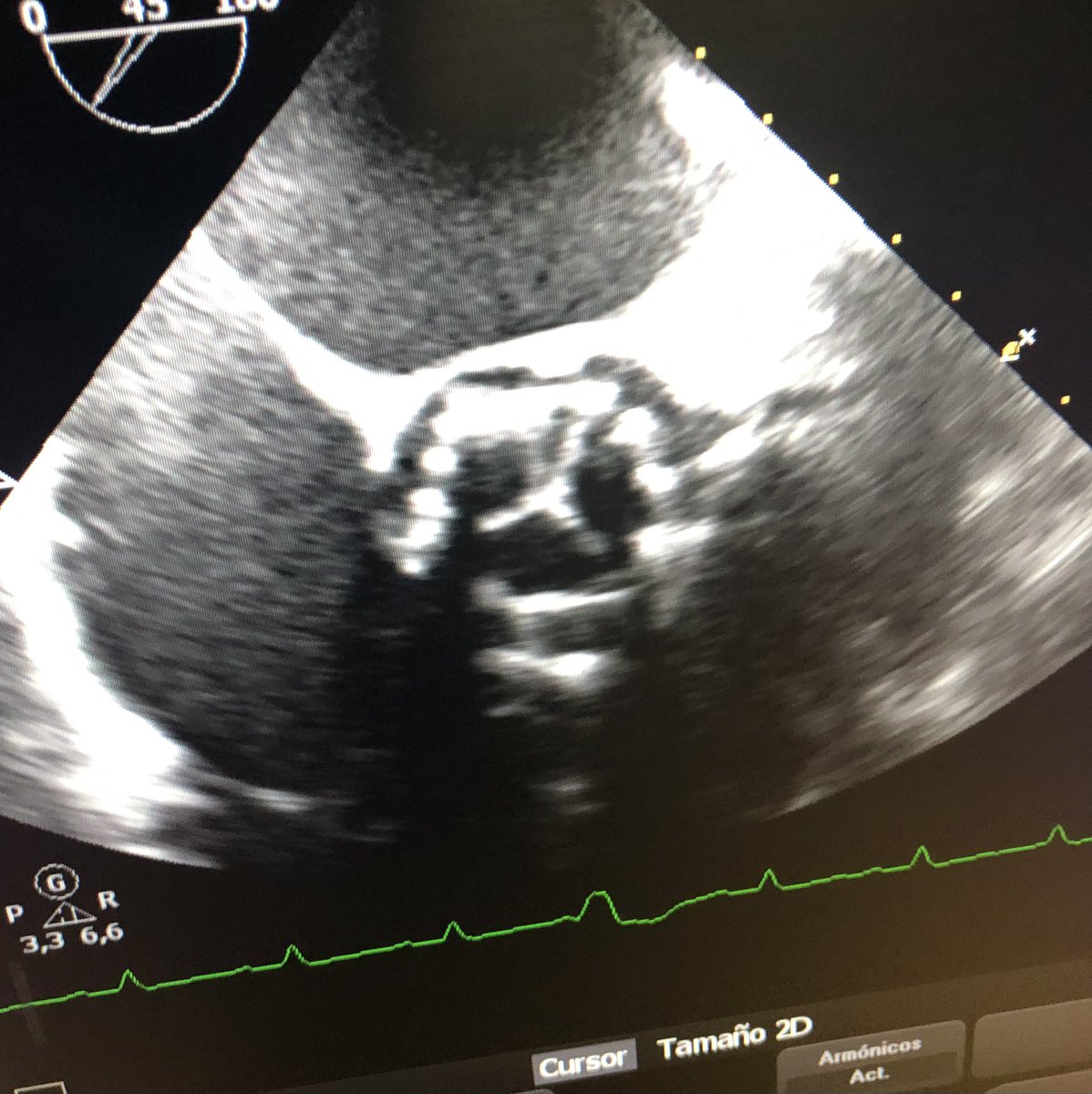 CorazonHuvr's tweet photo. #CodigoTAVI paciente de 64 años Estenosis aórtica critica no previamente diagnosticada en edema agudo de pulmón. Prótesis Edwards número 29 implantada de forma urgente a última hora de la tarde con excelente resultado hemodinámico y clínico. @HospitalUVRocio @SACardiologia https://t.co/XqAangXi1h