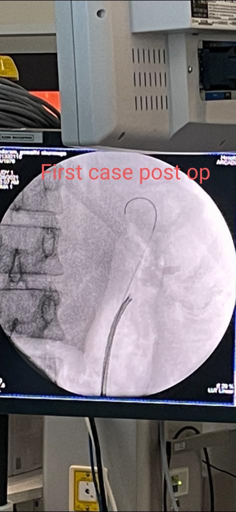 Housbow's tweet photo. New case with our ILY ROBOT at @AlZahraHospital by Dr Ahmed Hassan
45 yo female with left large Staghorn stone 4cm×3.5cm×2.1cm size density 1369 HU did it completely in one time!
URS @PusenMedical @ElviePeng
Laser @bsc_urology
#firstinUAE #firstinMiddleEast
#kidneystone https://t.co/QA4m0dtSRv