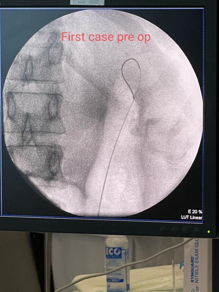 Housbow's tweet photo. New case with our ILY ROBOT at @AlZahraHospital by Dr Ahmed Hassan
45 yo female with left large Staghorn stone 4cm×3.5cm×2.1cm size density 1369 HU did it completely in one time!
URS @PusenMedical @ElviePeng
Laser @bsc_urology
#firstinUAE #firstinMiddleEast
#kidneystone https://t.co/QA4m0dtSRv