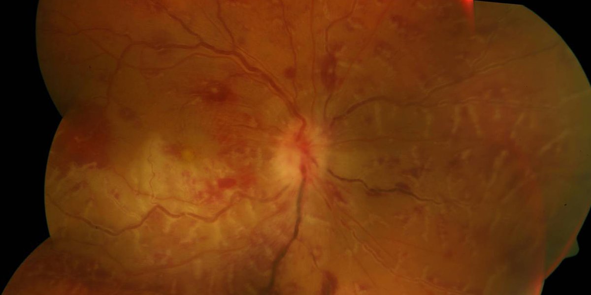 Frosted branch #angiitis, which has the appearance of frosted branches of a tree, describes inflamed blood vessels within the eye. ow.ly/Sjst50H9GEK Learn more about #retinalvasculitis !