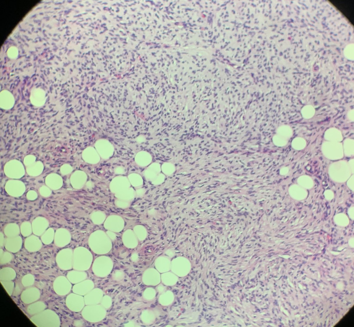 34 year old female abdomen, sent in as cyst #dermpath <a href="/david_terrano/">David Terrano</a> <a href="/tonitatirado/">Mariantonieta Tirado</a> <a href="/redsnapperpath/">Allison Osmond MD MSc FRCPC</a> <a href="/PIorfino/">Dermpath_doc_trish</a> <a href="/HENRYY_MD/">Henry YANG</a> <a href="/DrGeeONE/">Olaleke Folaranmi</a> <a href="/mvmd0908/">Pathology</a> <a href="/JMGardnerMD/">Jerad Gardner, MD</a> <a href="/ChristineJKoMD/">Christine J. Ko, MD</a> <a href="/kis_lorand/">Lorand Kis</a> <a href="/JamesSampson123/">James Sampson</a> <a href="/ASDPTweets/">American Society of Dermatopathology</a> #BSTPath
