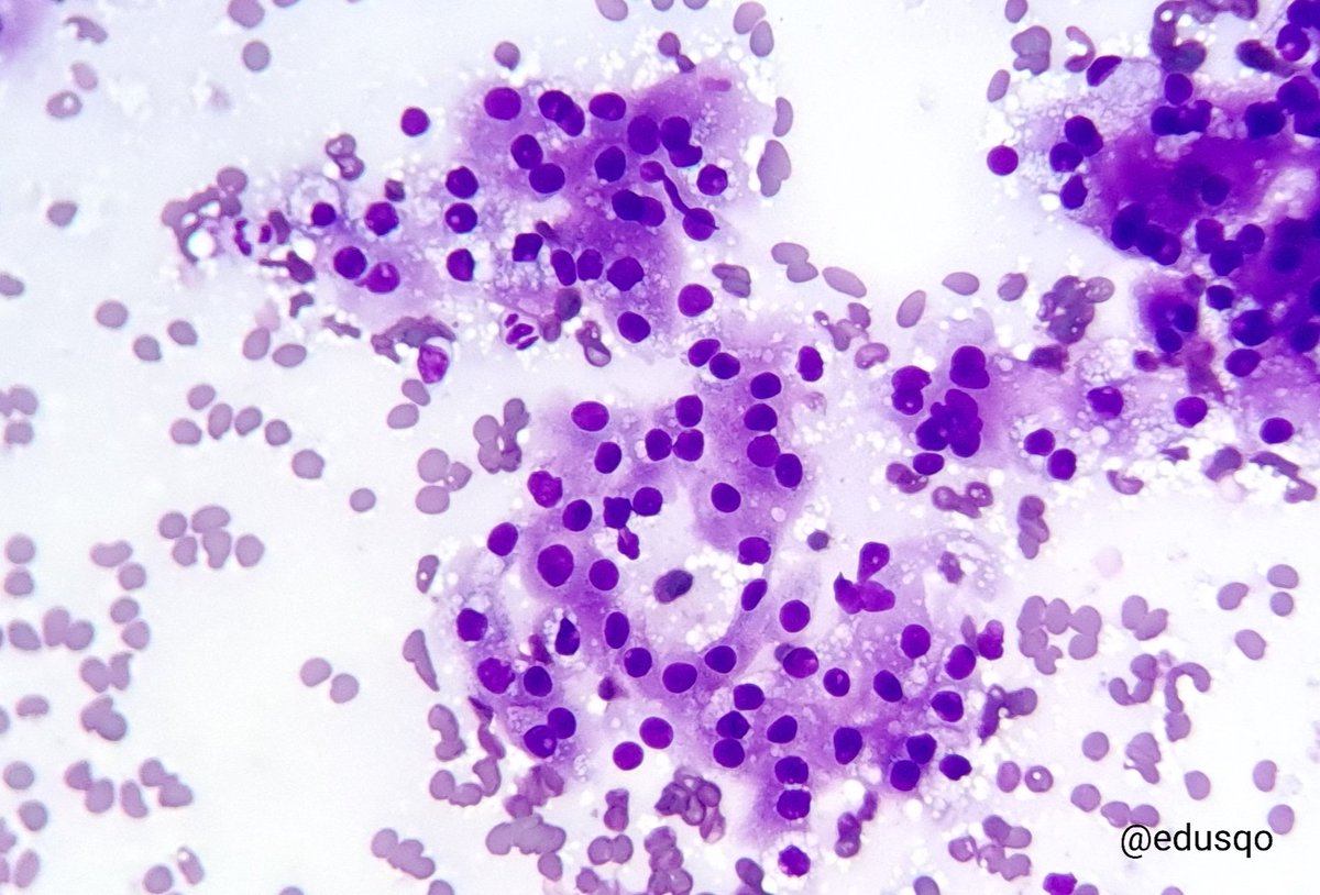 edusqo's tweet photo. Let's see some smears. I know you love it, #CytoPath lovers.
#DiffQuik first. https://t.co/ba5164PdNS