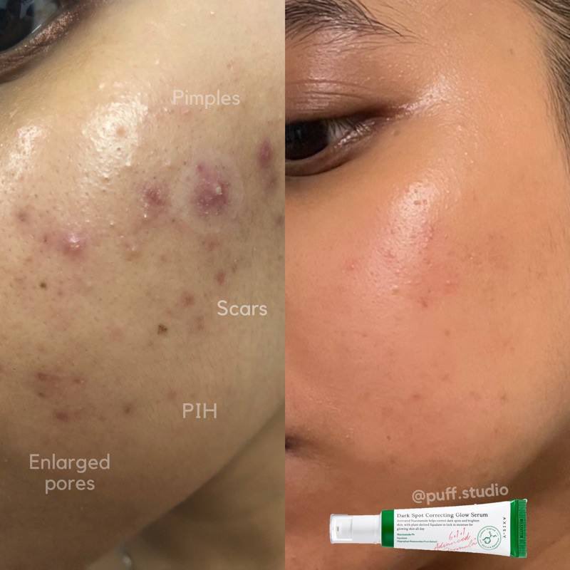 theiceraf's tweet photo. struggle nak matikan jerawat tu bukan main makan tahun tau, tapi serum ni berdesup jerawat aku kecut! parut pon pudar mmg 2 in 1

seller ni buat sale new year!
link: https://t.co/YovZsMamIS

Before:                  after: https://t.co/P4plvdEuGc