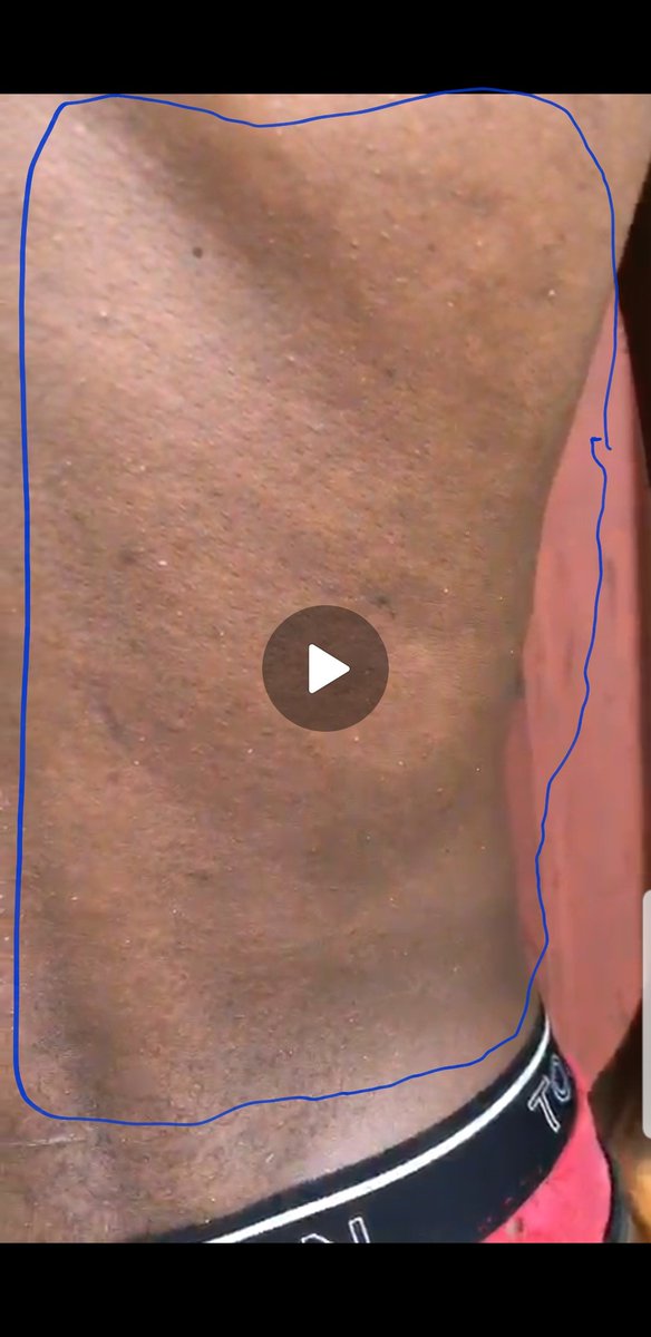 AdeleChimenem's tweet photo. @DalotDiogo @ManUtd @RareDiseases @meetjeo @JehuTFT @Call_me_ugo @dollarpresh @elegantiyawo @Mrleechious 7 years of torment, pains and sorrows. Those white dots u see with a closer look are the culprit tiny liquid logged blisters that has taken my life from me &amp; left me struggling to be alive every single day! And not giving into the very severe life threatening anxiety daily! https://t.co/7Iq5tgr7Ib