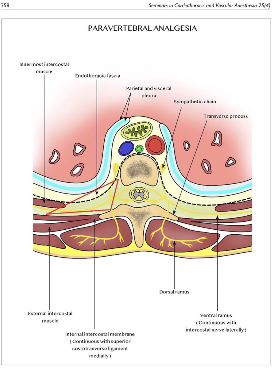 #RegionalAnalgesia for Cardiac Surgery Part 1. Current status of neuraxial and paravertebral blocks for adult cardiac #surgery: impact in suppressing hemodynamic stress response, reducing pulmonary complications, development of chronic pain. 
journals.sagepub.com/doi/full/10.11…