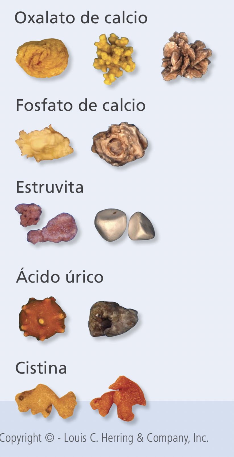 Mariscos Ruina Seguro Un_tal_urólogo on Twitter: "Tipos de cálculos renales según su composición y frecuencia*: * Hasta 37% son una mezcla de oxalato cálcico más fosfato de calcio. https://t.co/cvE1NqvAcK" / Twitter Mariscos Ruina Seguro Un_tal_urólogo on Twitter: "Tipos de cálculos renales según su composición y frecuencia*: * Hasta 37% son una mezcla de oxalato cálcico más fosfato de calcio. https://t.co/cvE1NqvAcK" / Twitter