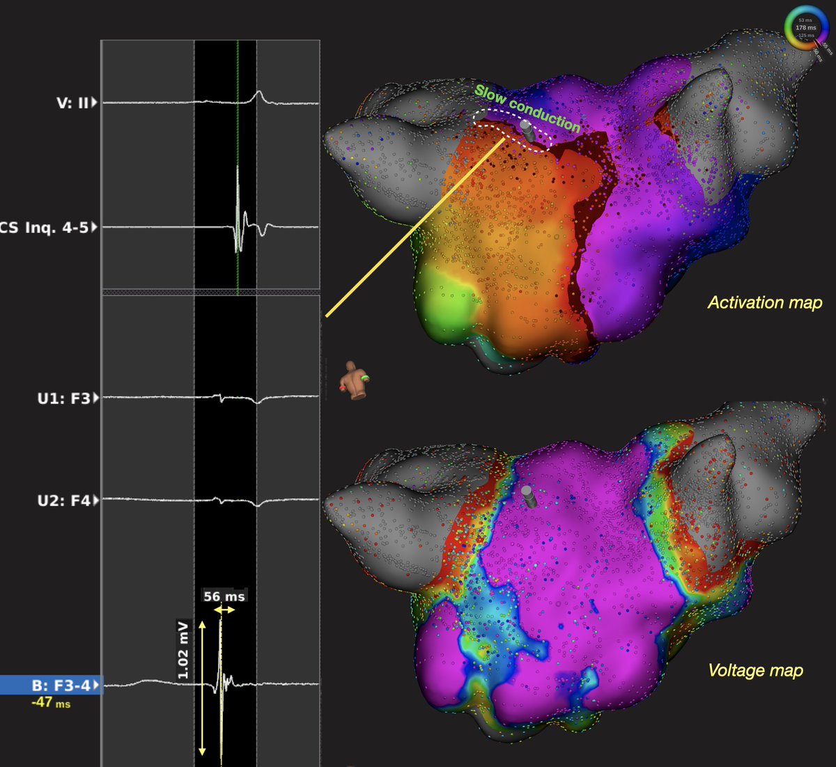 In patients with atrial fibrillation, mapping during sinus rhythm shows that slow conduction occur over area considered by everyone as HEALTHY (>0.5 mV).Here EGM corresponding to slow conduction corridor was 1 mV! Time to redefine voltage? FullManuscript bit.ly/3mlvhyx