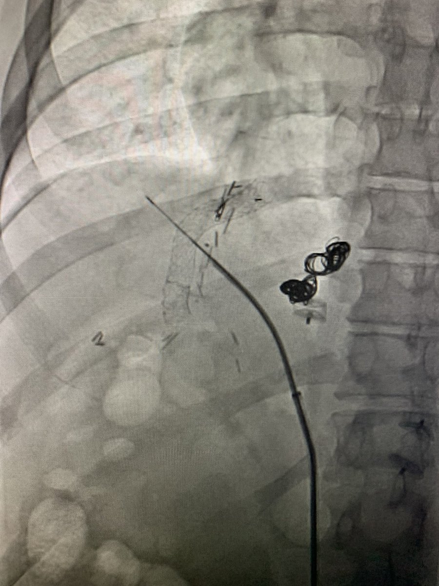 Post liver txp+TIPS referred for TJLB. Would anyone try TJ approach? Transfem transcaval (TFTC) works too and very quick! 1) Add another curve to metal cannula, 2) aim lateral, 3) make sure needle doesn’t go thru TIPS. <a href="/dotter_IR/">The Dotter Institute</a> <a href="/MontefioreRAD/">Montefiore Radiology</a> <a href="/SIR_ECS/">SIR ECS</a> <a href="/SIRRFS/">SIR RFS</a>