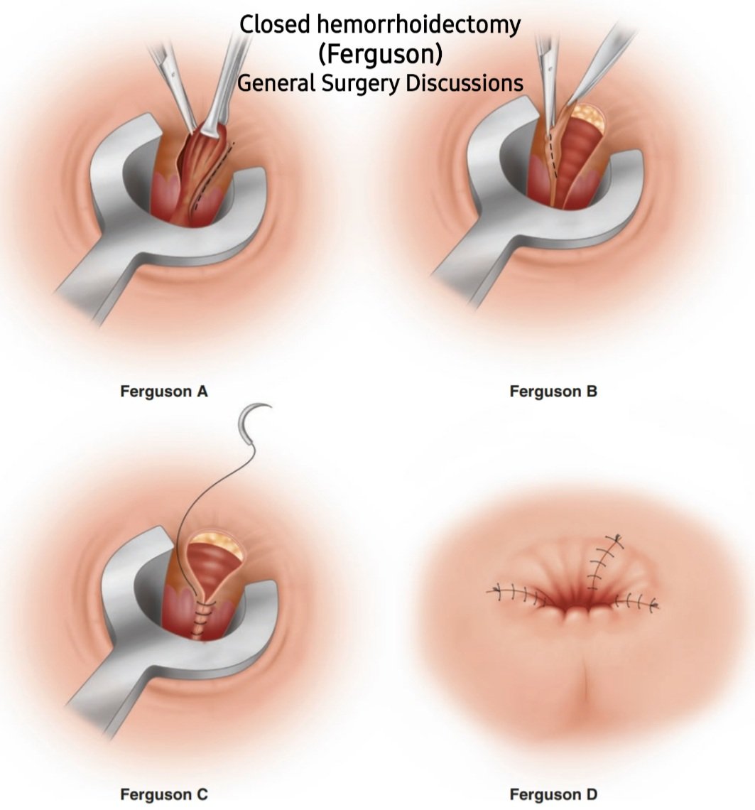 DR AFTAB AHMED on Twitter: "🅐︎ Excisional Hemorrhoidectomy Closed Technique (Ferguson Technique) 🆚 🅑︎ Excisional Hemorrhoidectomy Open Technique(Milligan-Morgan) #SoMe4IQLatAm #SoMe4Surgery #Medtwitter #4KMedEd #gastrointestinal #Colorectal ...