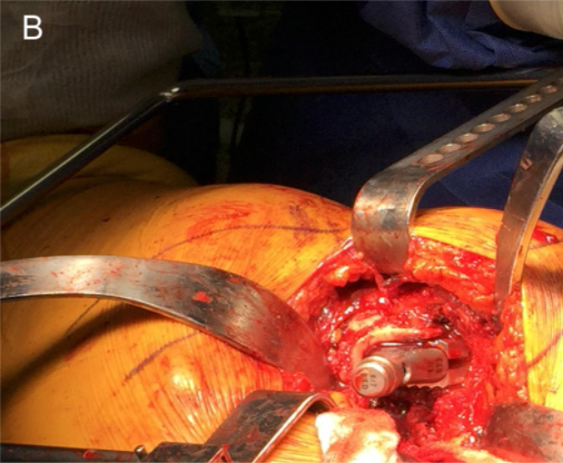 jbjs's tweet photo. Acetabular Component and Liner Selection for the Prevention of Dislocation After Primary Total Hip Arthroplasty #THA #orthotwitter

@DrPeterSculco @KyleKunzeMD @Dr_APremkumar  @HSSProfEd https://t.co/cLMYD8M52f