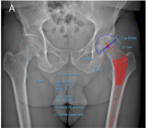 jbjs's tweet photo. Acetabular Component and Liner Selection for the Prevention of Dislocation After Primary Total Hip Arthroplasty #THA #orthotwitter

@DrPeterSculco @KyleKunzeMD @Dr_APremkumar  @HSSProfEd https://t.co/cLMYD8M52f