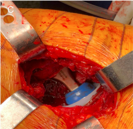 jbjs's tweet photo. Acetabular Component and Liner Selection for the Prevention of Dislocation After Primary Total Hip Arthroplasty #THA #orthotwitter

@DrPeterSculco @KyleKunzeMD @Dr_APremkumar  @HSSProfEd https://t.co/cLMYD8M52f