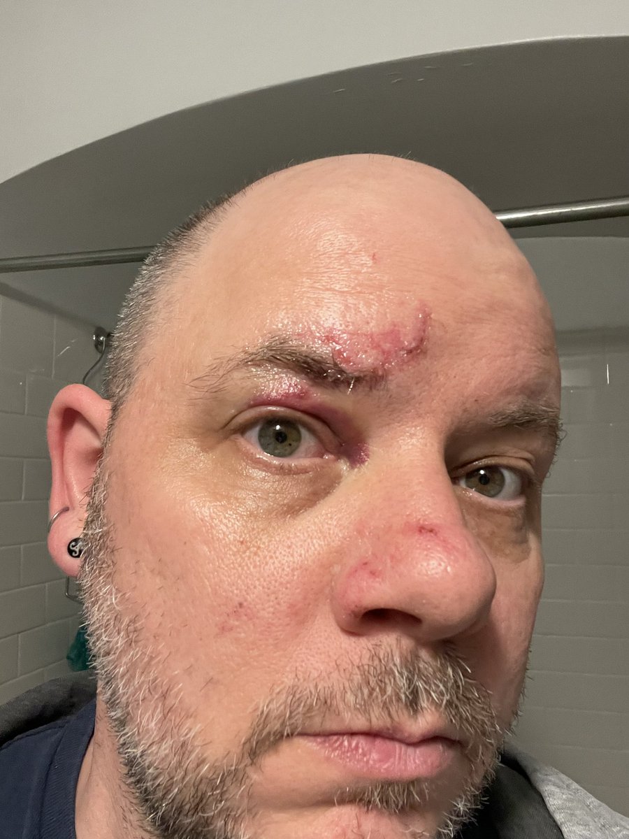 PNWFietser's tweet photo. Luckily I was seen by a pretty skilled physician who patched me up well. But I’m bruised all over and have a sore back and black eye in addition to being without my bike for several days. https://t.co/EdseQJYZgu