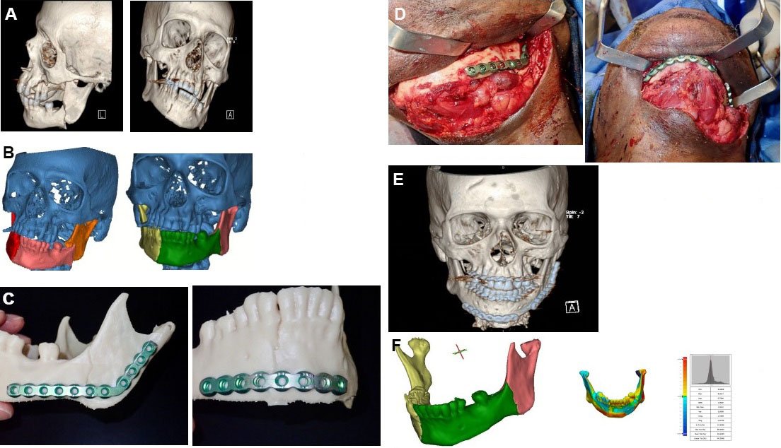 PARjournal's tweet photo. Article sharing:Point-of-care three-dimensional printing for #craniomaxillofacial #trauma
https://t.co/JuaqevivUj
#3D printing, #facial trauma
@cd_lopez_,@DrPunitDubey,@BaselSharafMD
,@DrGregFarwell, https://t.co/Y8VEvP4pVK