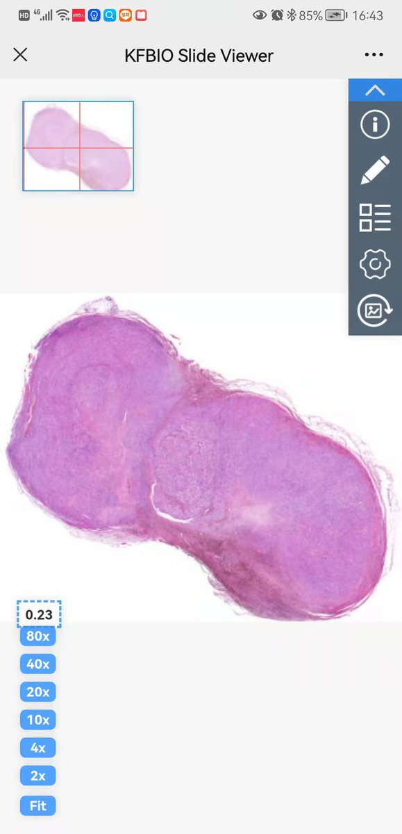 KFBIO1's tweet image. Remote share a pathology digital image by a website link or QR code
Then you can diagnose pathology slides or interview a pathologist remotely
Unbelievable? just click the link below

#digitalpathologyt
#pathologyimage
#digitalslides

viewer.kfbio.cn/HTML5/Seadrago…
