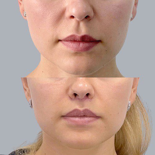 #Булхорн позволяет сократить расстояние между носом и красной каймой верхней губы за счёт иссечения части кожи. 
В результате губа немного выворачивается и становится более пухлой и полной.
Эффект после операции – естественная красота, губы выглядят натурально и привлекательно.