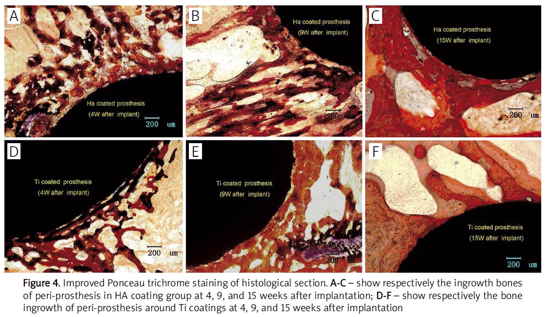 RBResearchTeam's tweet image. The comparatively low adhesive strength between the coating &amp;amp; the substrate affects the in vivo stability of HA-coated prostheses. The shear strength of HA-coated prostheses is much lower than that of Ti-coated implants. 
Source: DOI 10.1007/s12010-008-8391-0
SHARED BY: Haikal