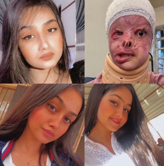 Die 16-jährige Irakerin Maryam Al Rikabi verweigerte sich einem Mann und bezahlte das fast mit ihrem Leben. Die Säure-Attacke überlebte sie nur knapp. So lange ich kann, werde ich auf solch frauenfeindliche Gewalt hinweisen. Das muss aufhören! #Misogynie gofund.me/29c4cbd1