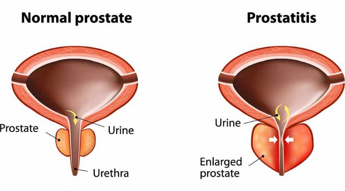 UshaDiamonds's tweet photo. Generally,  a  swollen prostate becomes grounds for prostate cancer, many males are under stress that has serious prostate.              https://t.co/TGLuMfYaCS https://t.co/eWSd960DoS