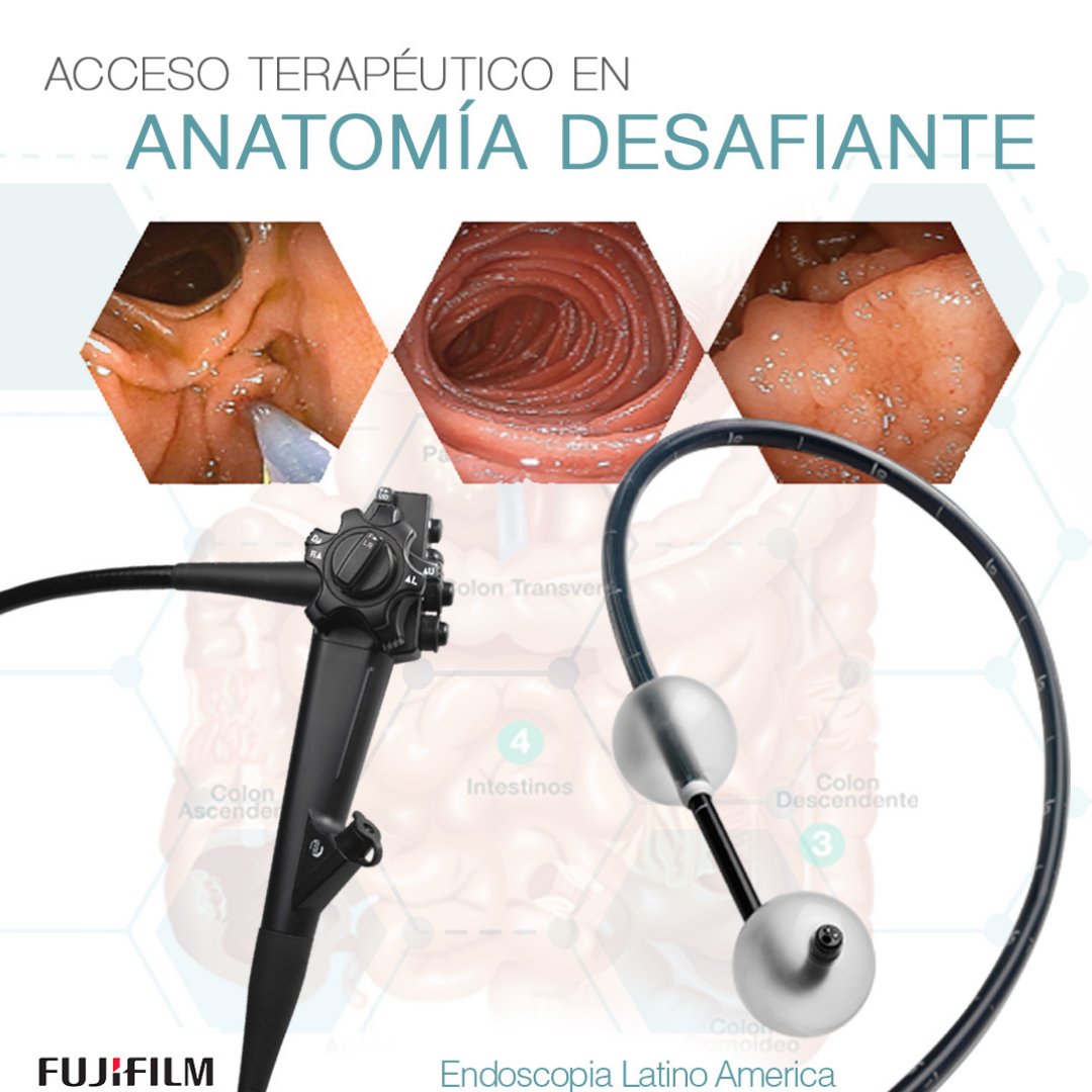 FujifilmLA's tweet photo. Con el desarrollo de Fujifilm para la endoscopia de doble balón se ha conseguido un nivel de acceso sin precedentes en el examen del intestino delgado.

#IEE #Gastro #Gastroenterologia #endoscopista #tractodigestivo #dbe #LCI #BLI #FujiFIlmEndoscopia #Endoscopia #vanguardia https://t.co/09Q6ga4TJg