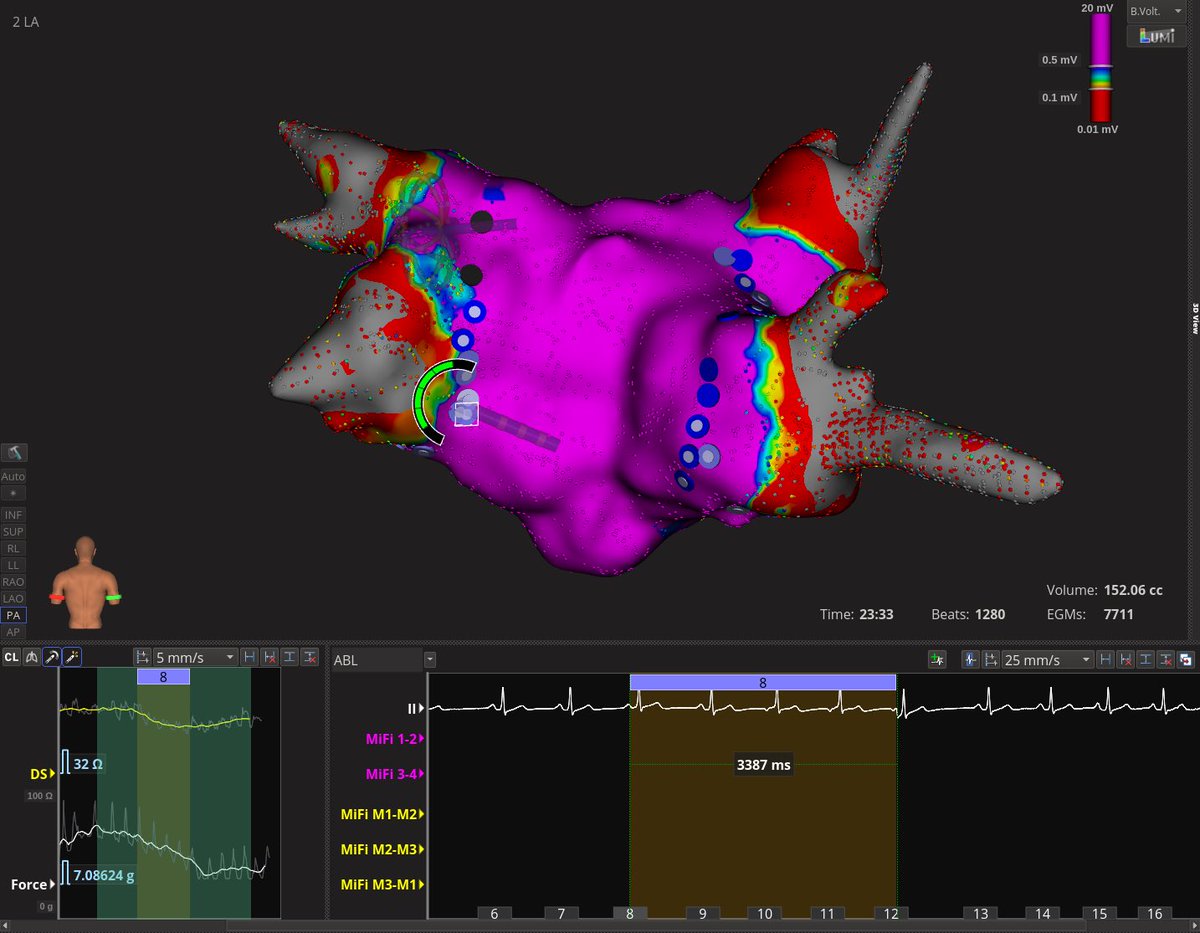 DrRamonAntonio's tweet photo. One of my favorites case done this December, AF ablation case with Rhythmia guided with Contact Force and Local Impedance.🙏 Thanks God a my mentors⚡️#EPeeps https://t.co/cVohUxbRRj