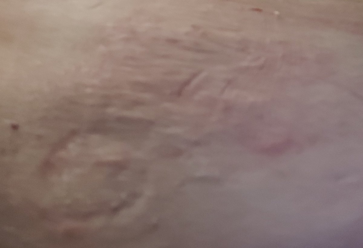 ejs29th's tweet image. Do I need to worry? I have allergy to #elastoplast not been sensitive to any cannula sticky part before. But day 2 #setchange #day #trusteel  #tslim #tandemdiabetes my skin is so itchy and looks like picture 
Do I need to change type I use? Or some sort of #barrier film?