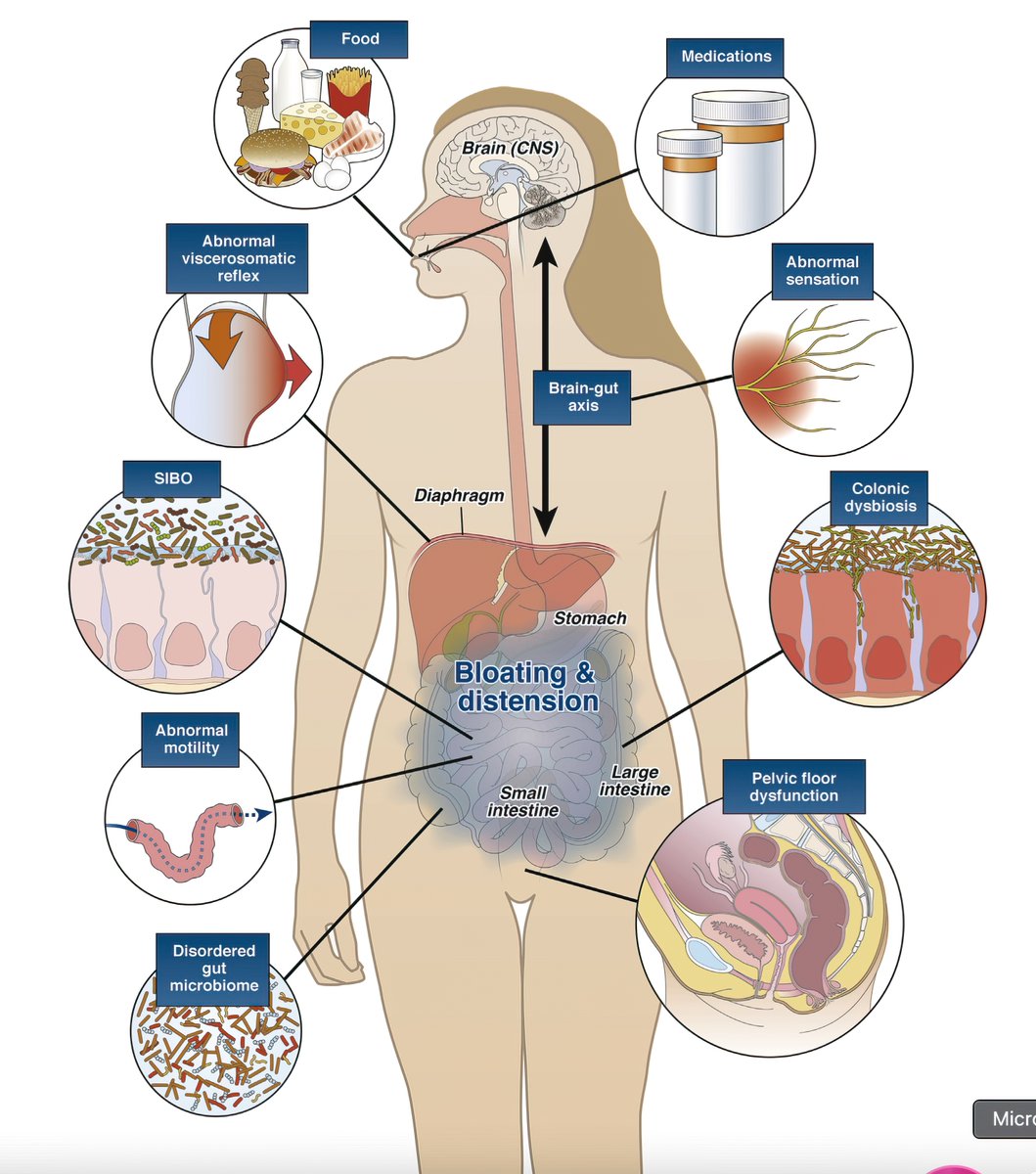 Causes and management of bloating #GITwitter #4KMedEd (via @AGA_CGH)https:/...