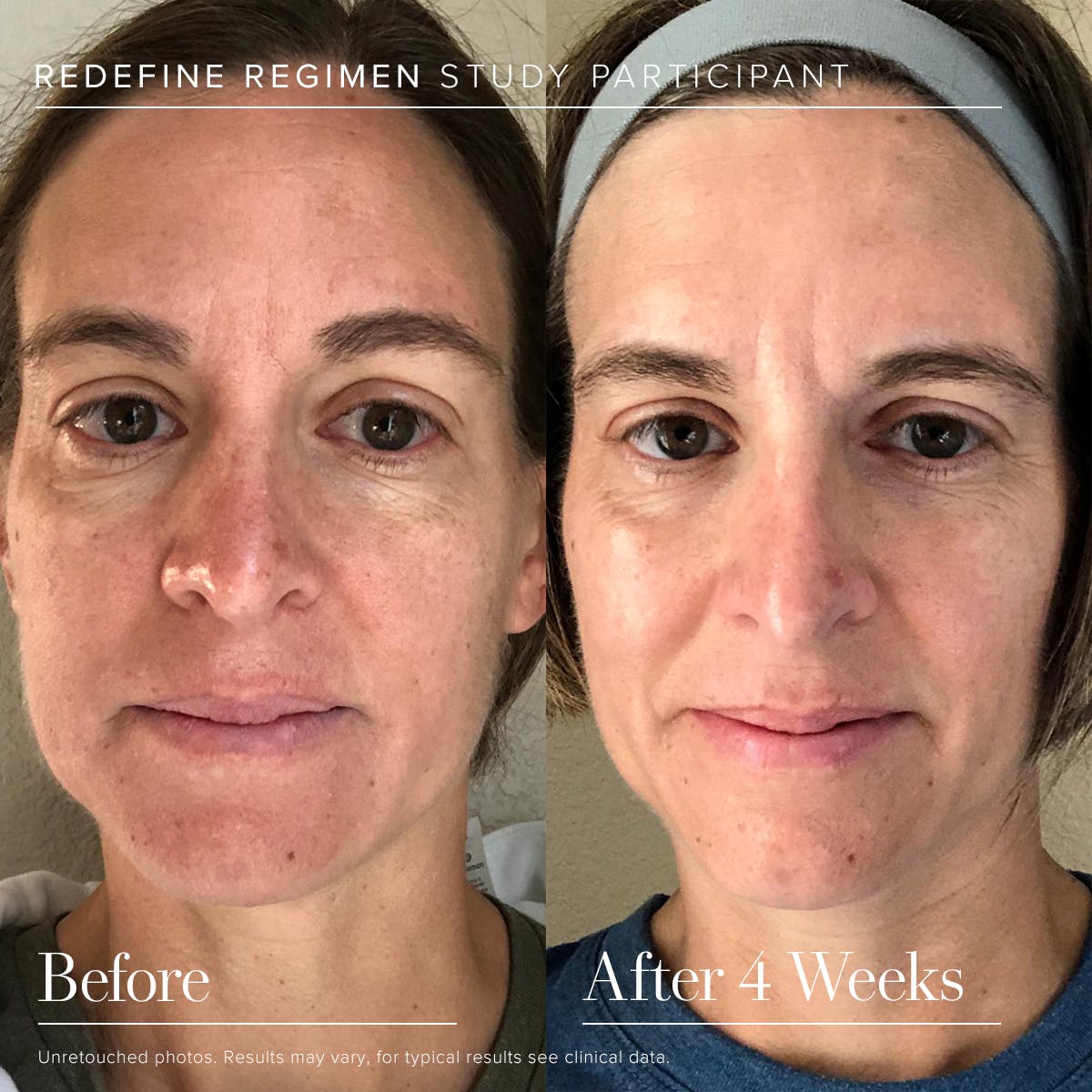Baby steps to better looking skin. This is 4 weeks, just think what a year could look like! go.rodanandfields.com/4xzq94
