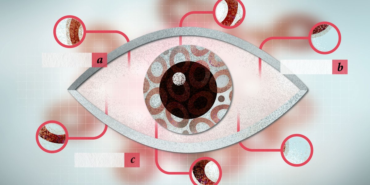 bpacnz (@bpacnz) on Twitter photo Part 2 of our series on melanoma: follow-up and surveillance after curative intent treatment, is available here: bpac.org.nz/2021/melanoma-…
#melanoma #skincancer #Cancer <a href="/cancer_agency/">Te Aho o Te Kahu | Cancer Control Agency NZ</a> Part 2 of our series on melanoma: follow-up and surveillance after curative intent treatment, is available here: bpac.org.nz/2021/melanoma-…
#melanoma #skincancer #Cancer <a href="/cancer_agency/">Te Aho o Te Kahu | Cancer Control Agency NZ</a>