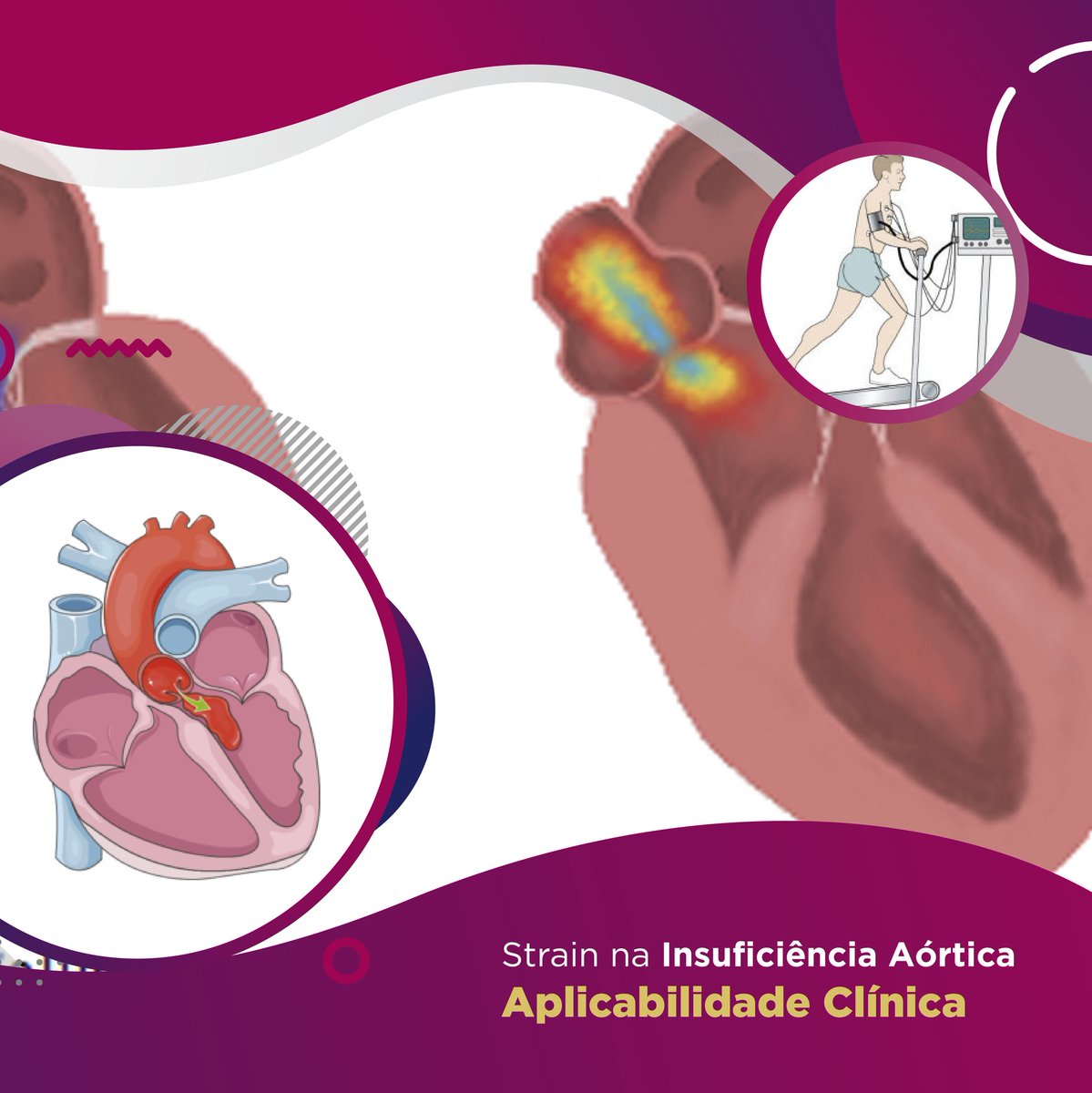 Myocardial Strain is well established in Aortic Stenosis, and is included in some aspects of the Guidelines.
.
In other valve diseases, this is different… In Aortic Regurgitation, does it have clinical applicability?
.
Go to thevalveclub.com.br