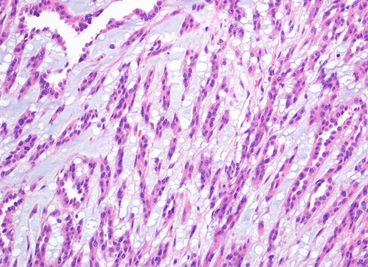 Great example of Mucinous Tubular &amp; Spindle cell carcinoma of Kidney #kidneycancer #gupath #pathology <a href="/UMichPath/">Michigan Pathology</a> #pathresidents